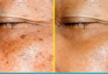 მოიშორეთ ნაოჭები, ჭორფლი და პიგმენტური ლაქები ამ საოცარი ლოსიონის დახარებით! ნახეთ რეცეპტი…