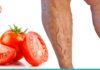 როგორ ვუმკურნალოთ ვენების ვარიკოზულ დაავადებას პომიდვრის დახმარებით? მარტივი და ეფექტურია