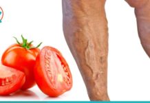 როგორ ვუმკურნალოთ ვენების ვარიკოზულ დაავადებას პომიდვრის დახმარებით? მარტივი და ეფექტურია