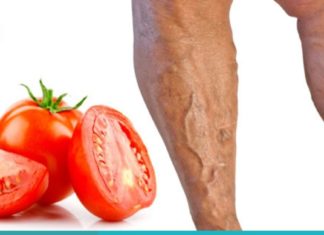 როგორ ვუმკურნალოთ ვენების ვარიკოზულ დაავადებას პომიდვრის დახმარებით? მარტივი და ეფექტურია