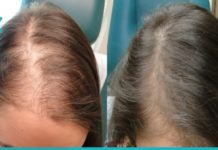 ეს ყველაზე ეფექტური ნიღაბია თმის ცვენის წინააღმდეგ. უბრალოდ უნდა სცადოთ!