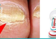 ფრჩხილის სოკო სამუდამოდ დავამარცხე! ამაში კი აი ეს საშუალებები დამეხმარა