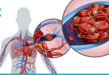 თრომბის განვითარების 10 სიმპტომი, რომლებიც უნდა იცოდეთ. მოუსმინეთ თქვენს ორგანიზმს!