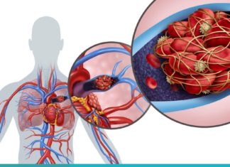 თრომბის განვითარების 10 სიმპტომი, რომლებიც უნდა იცოდეთ. მოუსმინეთ თქვენს ორგანიზმს!