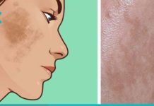 ამ რეცეპტის დახმარებით სამუდამოდ გაიქრობთ პიგმენტურ ლაქებს. აუცილებლად სცადეთ