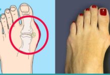 პოდაგრის მკურნალობის ყველაზე მარტივი და ეფექტური გზა. მხოლოდ იოდი და ასპირინი დაგჭირდებათ