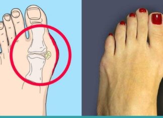 პოდაგრის მკურნალობის ყველაზე მარტივი და ეფექტური გზა. მხოლოდ იოდი და ასპირინი დაგჭირდებათ