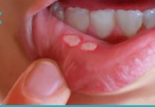 როგორ მოვიშოროთ სტომატიტი სახლის პირობებში? დაემშვიდობეთ ამ პრობლემას მარტივად