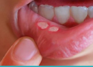 როგორ მოვიშოროთ სტომატიტი სახლის პირობებში? დაემშვიდობეთ ამ პრობლემას მარტივად