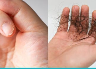 თუ თმა გცვივათ და ფრჩხილები გტყდებათ, მიიღეთ ეს ნაზავი