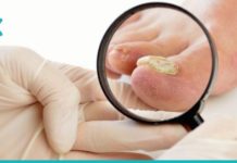 3 ეფექტური საშუალება ფრჩხილის სოკოს მოსაშორებლად