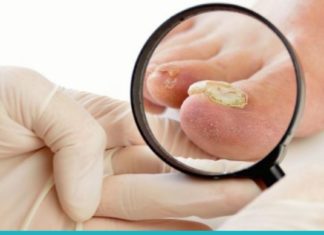 3 ეფექტური საშუალება ფრჩხილის სოკოს მოსაშორებლად