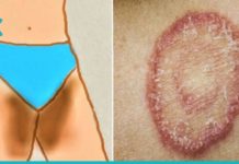 მოამზადეთ ეს საშუალება კანის სოკოვანი დაავადების (დერმატომიკოზის) სამკურნალოდ..