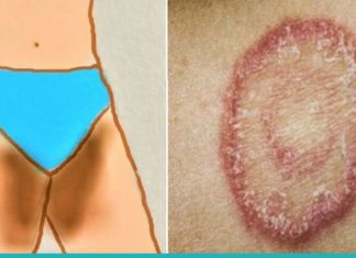 მოამზადეთ ეს საშუალება კანის სოკოვანი დაავადების (დერმატომიკოზის) სამკურნალოდ..