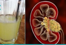 დაემშვიდობეთ თირკმელებში კენჭებს სულ რაღაც ერთ კვირაში. ეფექტური რეცეპტი