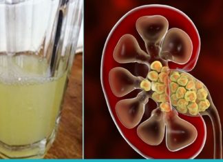 დაემშვიდობეთ თირკმელებში კენჭებს სულ რაღაც ერთ კვირაში. ეფექტური რეცეპტი