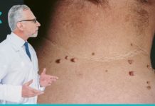 საუკეთესო გზები არასასიამოვნო პაპილომების მოსაშორებლად