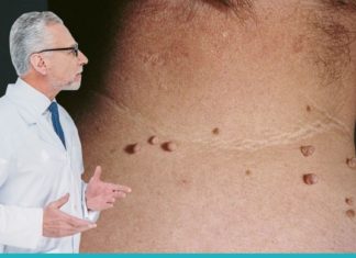 საუკეთესო გზები არასასიამოვნო პაპილომების მოსაშორებლად