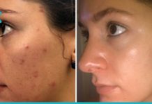 ეს 11 ნატურალური მეთოდი დაგეხმარებათ აკნეს დამარცხებაში!