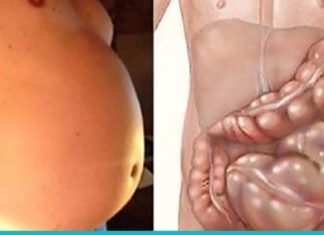 გათავისუფლდით გაზებისა და მუცლის შებერილობისგან სწრაფად და ეფექტურად ამ 7 საშუალებით!