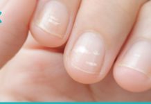 რისი მანიშნებელია ფრჩხილებზე არსებული თეთრი ლაქები? ეს უნდა იცოდეთ