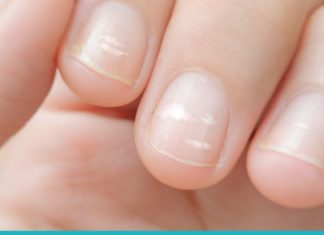 რისი მანიშნებელია ფრჩხილებზე არსებული თეთრი ლაქები? ეს უნდა იცოდეთ