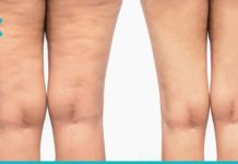 მარტივი და ხელმისაწვდომი საშუალებები ცელულუტის გასაქრობად. დაამარცხეთ ეს პრობლემა სამუდამოდ