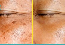 სახის ლაქები წამებში გაქრება! სცადეთ ეს ხალხური რეცეპტი!