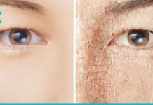 როგორ ვუმკურნალოთ გამომშრალ კანს ზამთარში? გამოსავალი ამ რეცეპტებშია!