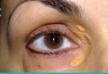 მოიშორეთ ქსანტელაზმები თვალებიდან სამუდამოდ! მხოლოდ ბუნებრივი მეთოდები