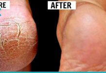 მხოლოდ და მხოლოდ 2 ინგრედიენტი იმისათვის, რომ თქვენი ქუსლები იდეალურად გამოიყურებოდეს