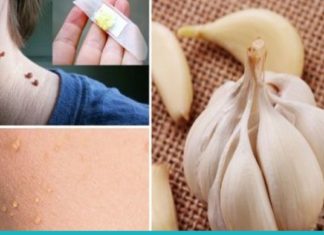 მეჭეჭების გაქრობის რამდენიმე მარტივი მეთოდი, რომელიც ამ პრობლემას სამუდამოდ დაგავიწყებთ