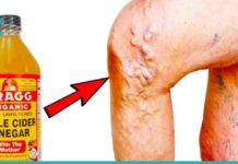 გამოიყენეთ ვაშლის ძმარი ამ გზით და შეძლებთ ვარიკოზული ვენების გაქრობას, წონის დაკლებას და სხვა.