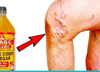 გამოიყენეთ ვაშლის ძმარი ამ გზით და შეძლებთ ვარიკოზული ვენების გაქრობას, წონის დაკლებას და სხვა.