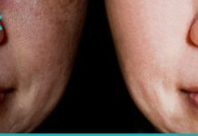 დაივიწყეთ ღია ფორები სახეზე ამ რეცეპტის დახმარებით. სუპერეფექტური მეთოდი!