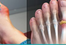 დაივიწყეთ ნიკრისის ქარის(პოდაგრა) დაავადება სამუდამოდ! ამაში ეს ხალხური საშუალებები დაგეხმარებათ