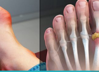 დაივიწყეთ ნიკრისის ქარის(პოდაგრა) დაავადება სამუდამოდ! ამაში ეს ხალხური საშუალებები დაგეხმარებათ