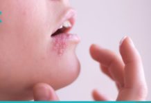 ხალხური მეთოდები, რომლებიც ერთ დღეში გაგათავისუფლებენ ჰერპესისგან!