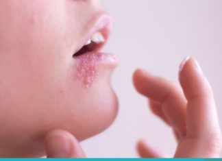 ხალხური მეთოდები, რომლებიც ერთ დღეში გაგათავისუფლებენ ჰერპესისგან!