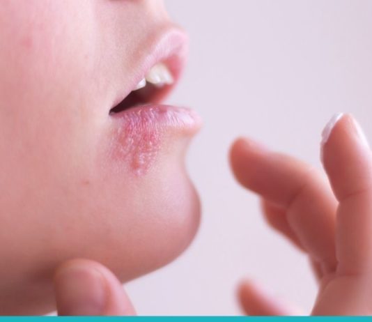 ხალხური მეთოდები, რომლებიც ერთ დღეში გაგათავისუფლებენ ჰერპესისგან!