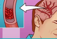 გაისუფთავეთ თავის ტვინის სისხლძარღვები სახლის პირობებში