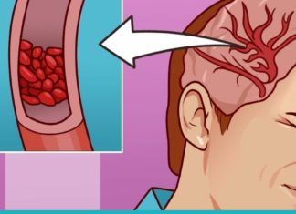 გაისუფთავეთ თავის ტვინის სისხლძარღვები სახლის პირობებში