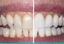 კბილების გათეთრება სახლის პირობებში. მარტივი და ეფექტური რეცეპტი