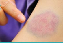 მარილი დაგეხმარებათ სისხლჩაქცევების გაქრობაში