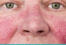 დააღწიეთ თავი კუპეროზის დაავადებას ამ ბუნებრივი მეთოდებით