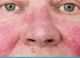 დააღწიეთ თავი კუპეროზის დაავადებას ამ ბუნებრივი მეთოდებით