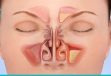 სინუსიტის მკურნალობა სახლის პირობებში ეფექტური და მარტივი მეთოდით