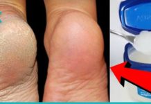 10 საშინაო სამკურნალო საშუალება სრულყოფილი ფეხებისთვის