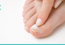 ამ საშუალებას “სოკოს მკვლელს უწოდებენ”. შედეგი გარანტირებულია!