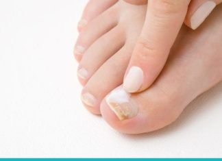 ამ საშუალებას “სოკოს მკვლელს უწოდებენ”. შედეგი გარანტირებულია!